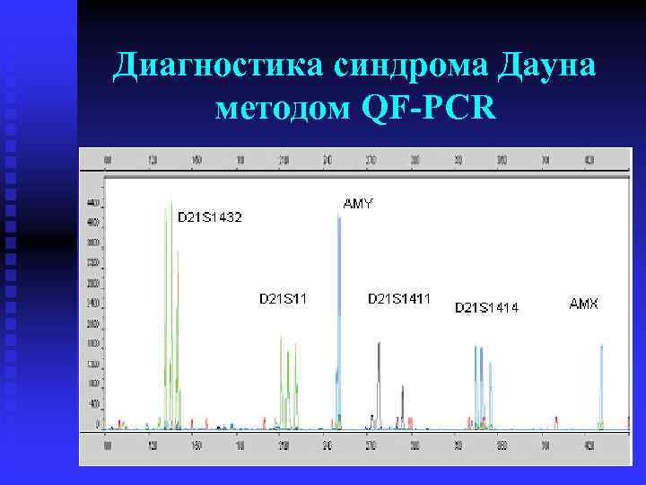 Диагностика синдрома Дауна методом QF-PCR 