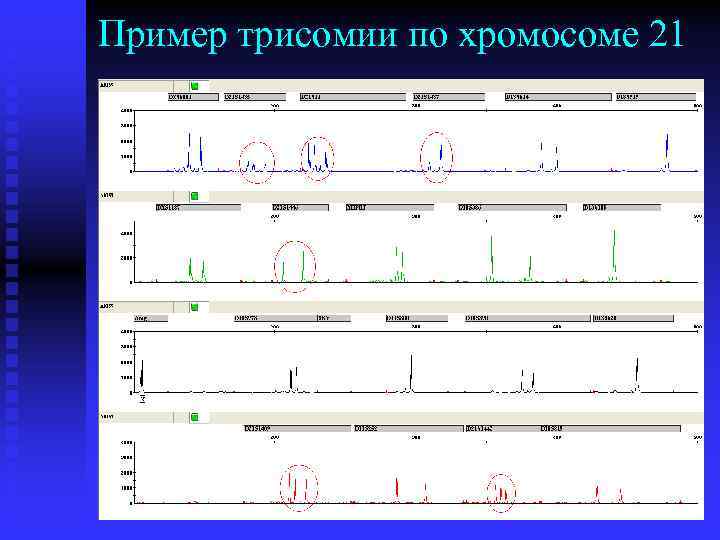 Пример трисомии по хромосоме 21 