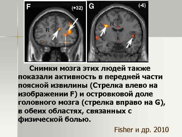 Снимки мозга этих людей также показали активность в передней части поясной извилины (Стрелка влево