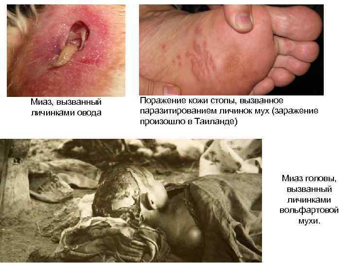 Миаз, вызванный личинками овода Поражение кожи стопы, вызванное паразитированием личинок мух (заражение произошло в