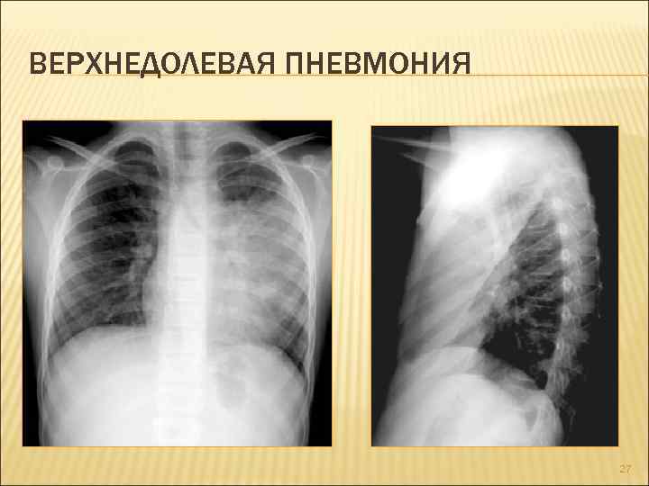 ВЕРХНЕДОЛЕВАЯ ПНЕВМОНИЯ 27 