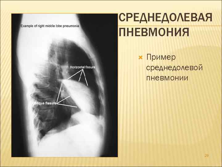 СРЕДНЕДОЛЕВАЯ ПНЕВМОНИЯ Пример среднедолевой пневмонии 29 