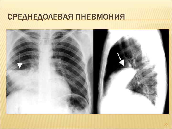 Пневмония легких у детей фото