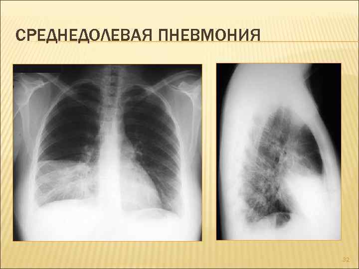 СРЕДНЕДОЛЕВАЯ ПНЕВМОНИЯ 32 