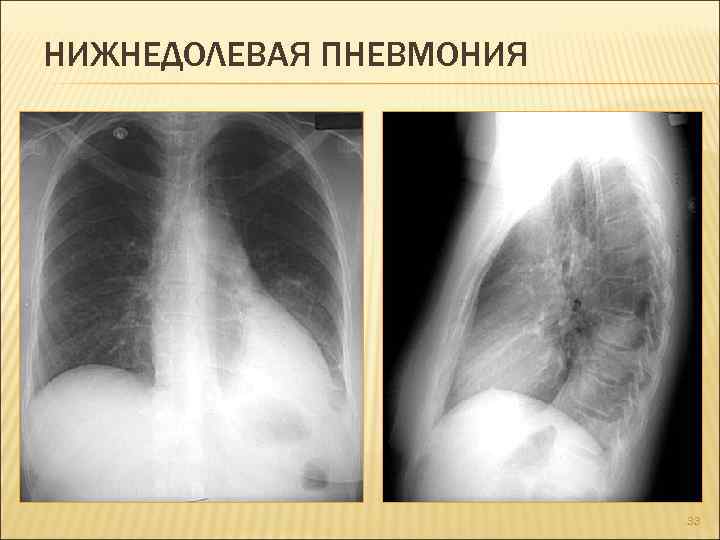 Нижняя пневмония. Внебольничная очаговая пневмония рентген. Внебольничная пневмония рентген. Правосторонняя нижнедолевая очаговая пневмония рентген. Нижнедолевая пневмония справа рентген.