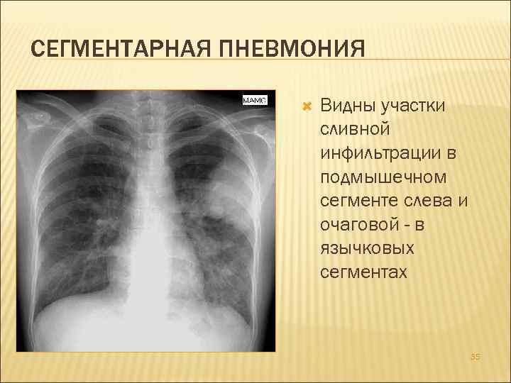 Полисегментарная пневмония карта вызова