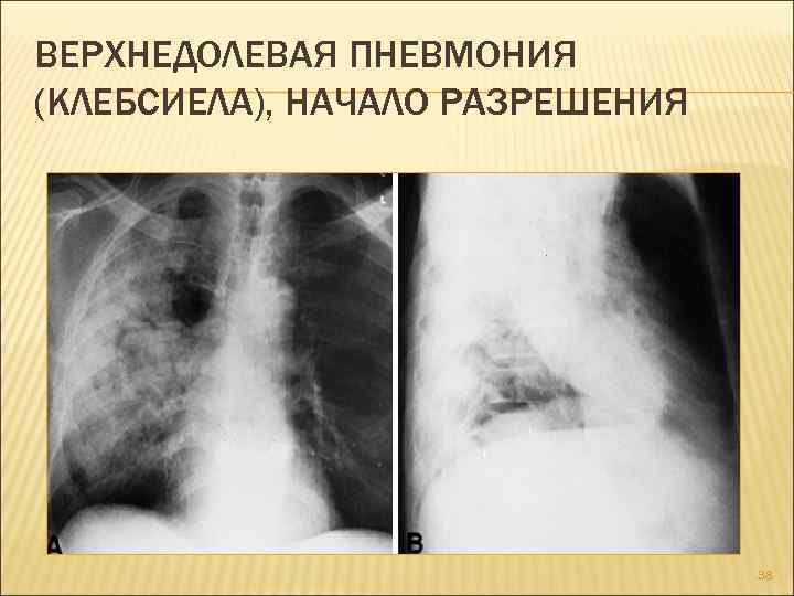 ВЕРХНЕДОЛЕВАЯ ПНЕВМОНИЯ (КЛЕБСИЕЛА), НАЧАЛО РАЗРЕШЕНИЯ 38 