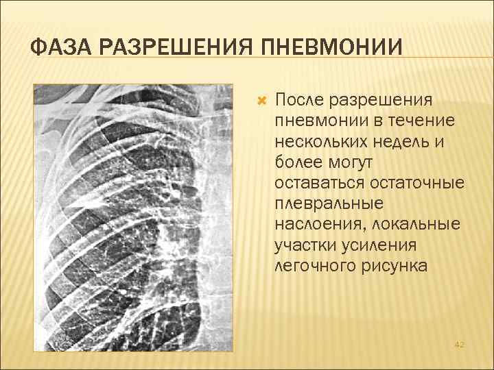 Степени пневмонии