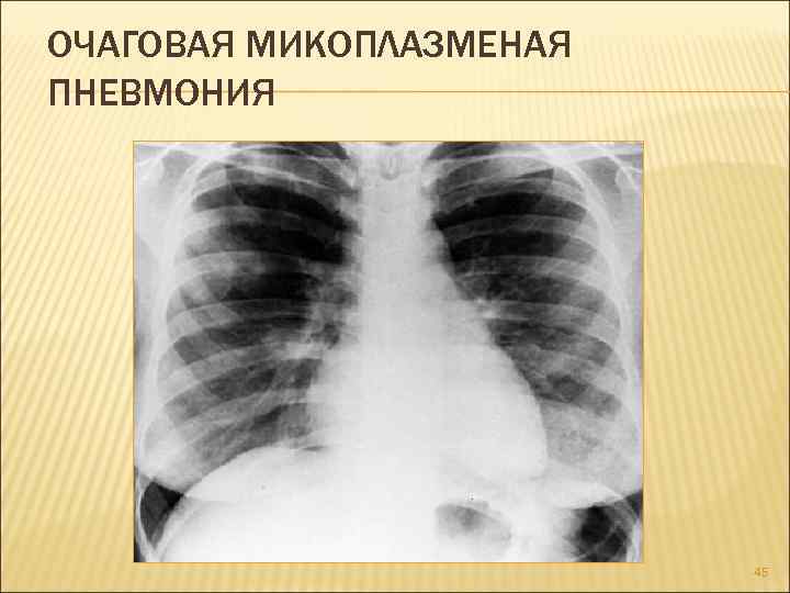 ОЧАГОВАЯ МИКОПЛАЗМЕНАЯ ПНЕВМОНИЯ 45 