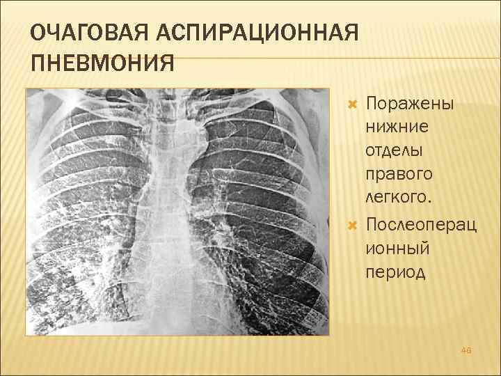 ОЧАГОВАЯ АСПИРАЦИОННАЯ ПНЕВМОНИЯ Поражены нижние отделы правого легкого. Послеоперац ионный период 46 