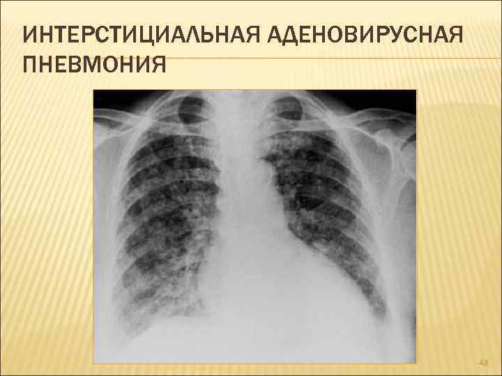 ИНТЕРСТИЦИАЛЬНАЯ АДЕНОВИРУСНАЯ ПНЕВМОНИЯ 48 