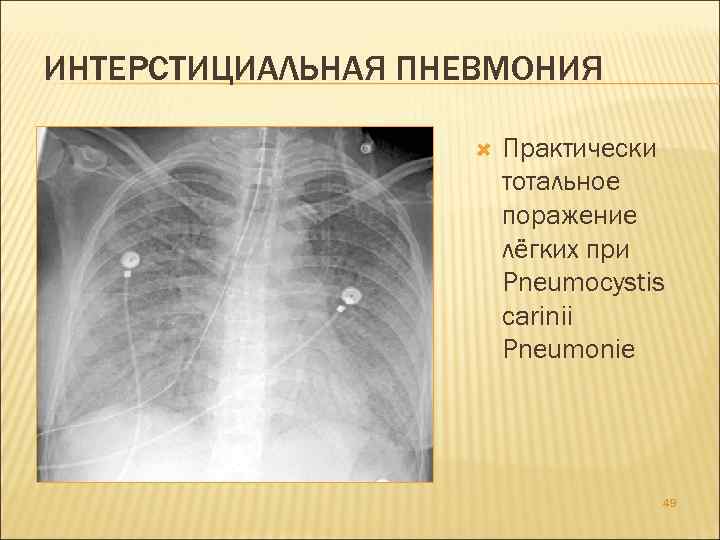 ИНТЕРСТИЦИАЛЬНАЯ ПНЕВМОНИЯ Практически тотальное поражение лёгких при Pneumocystis carinii Pneumonie 49 