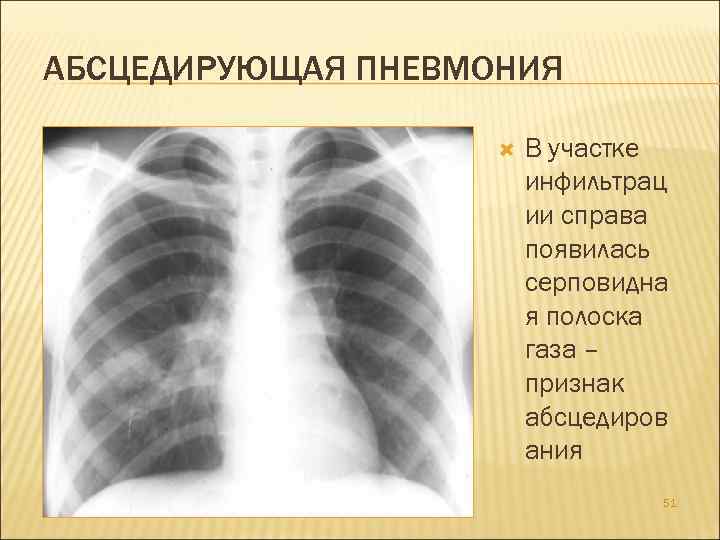 АБСЦЕДИРУЮЩАЯ ПНЕВМОНИЯ В участке инфильтрац ии справа появилась серповидна я полоска газа – признак