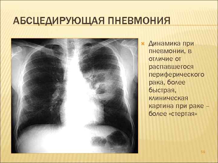 АБСЦЕДИРУЮЩАЯ ПНЕВМОНИЯ Динамика при пневмонии, в отличие от распавшегося периферического рака, более быстрая, клиническая