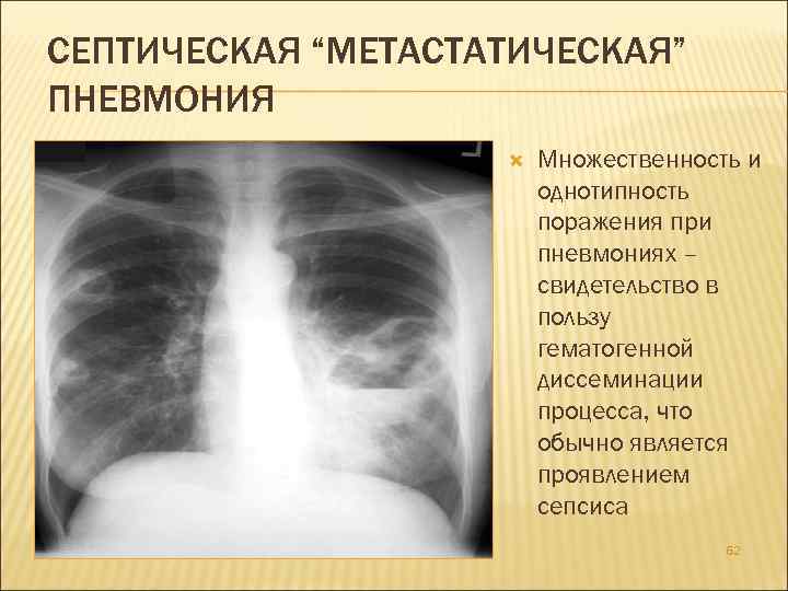 СЕПТИЧЕСКАЯ “МЕТАСТАТИЧЕСКАЯ” ПНЕВМОНИЯ Множественность и однотипность поражения при пневмониях – свидетельство в пользу гематогенной