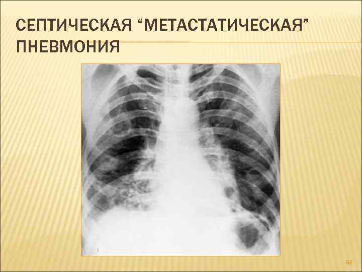 Полисегментарная пневмония