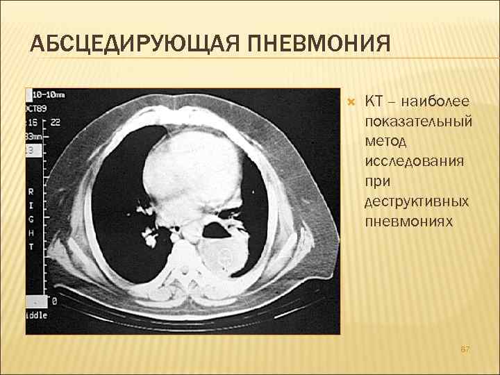 АБСЦЕДИРУЮЩАЯ ПНЕВМОНИЯ КТ – наиболее показательный метод исследования при деструктивных пневмониях 67 