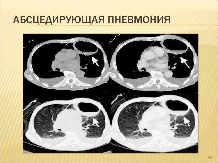 АБСЦЕДИРУЮЩАЯ ПНЕВМОНИЯ 68 