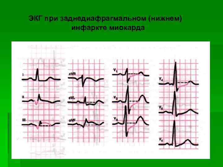 ЭКГ при заднедиафрагмальном (нижнем) инфаркте миокарда 