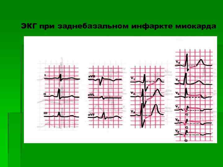 ЭКГ при заднебазальном инфаркте миокарда 