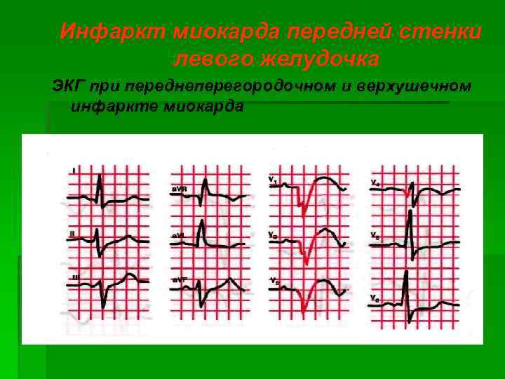 Инфаркт миокарда передней стенки левого желудочка ЭКГ при переднеперегородочном и верхушечном инфаркте миокарда 