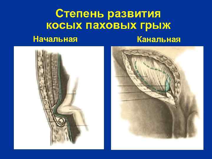 Степень развития косых паховых грыж Начальная Канальная 