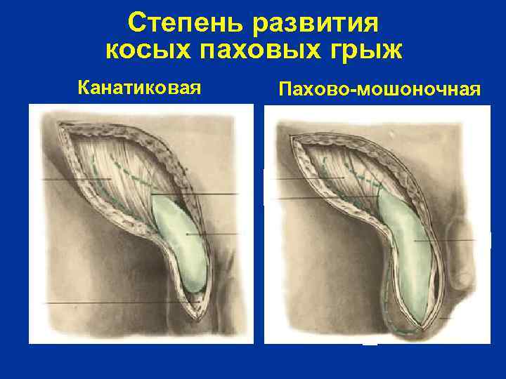Степень развития косых паховых грыж Канатиковая Пахово-мошоночная 