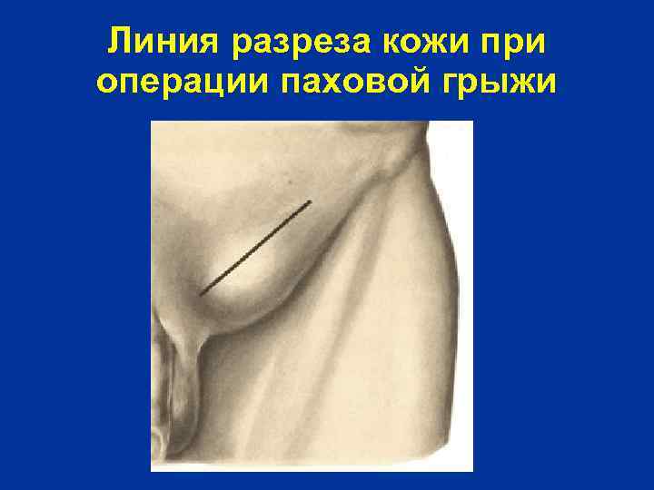 Линия разреза кожи при операции паховой грыжи 