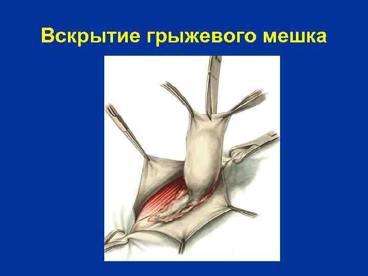 Вскрытие грыжевого мешка 