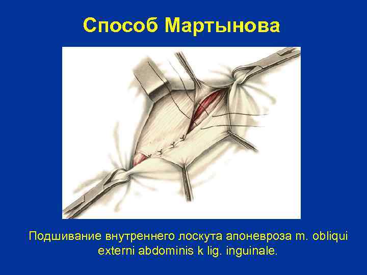 Способ Мартынова Подшивание внутреннего лоскута апоневроза m. obliqui externi abdominis k lig. inguinale. 