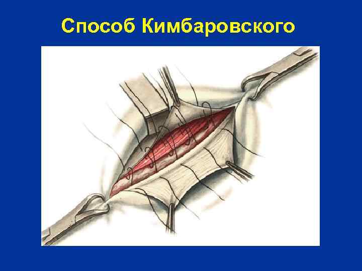 Способ Кимбаровского 