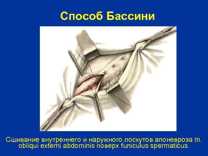 Способ Бассини Сшивание внутреннего и наружного лоскутов апоневроза m. obliqui externi abdominis поверх funiculus