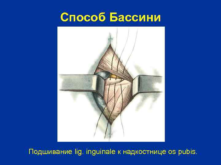 Способ Бассини Подшивание lig. inguinale к надкостнице os pubis. 