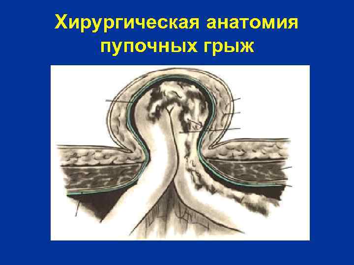 Хирургическая анатомия пупочных грыж 