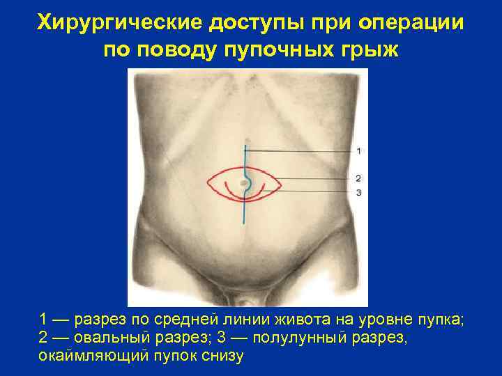 Хирургические доступы при операции по поводу пупочных грыж 1 — разрез по средней линии