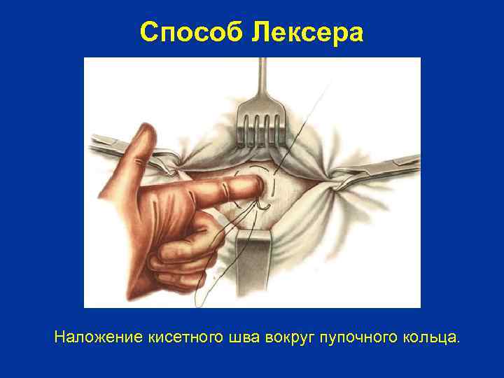 Способ Лексера Наложение кисетного шва вокруг пупочного кольца. 