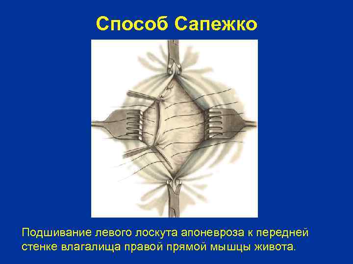 Способ Сапежко Подшивание левого лоскута апоневроза к передней стенке влагалища правой прямой мышцы живота.