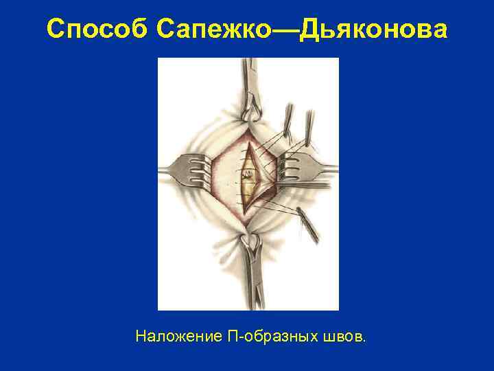 Способ Сапежко—Дьяконова Наложение П-образных швов. 