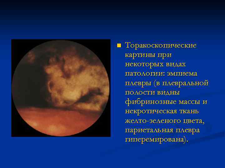 n Торакоскопические картины при некоторых видах патологии: эмпиема плевры (в плевральной полости видны фибринозные