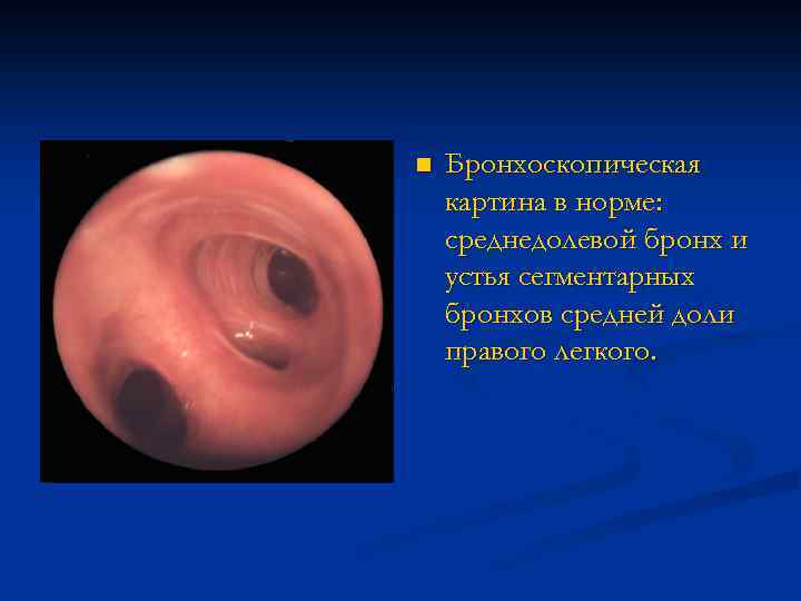n Бронхоскопическая картина в норме: среднедолевой бронх и устья сегментарных бронхов средней доли правого
