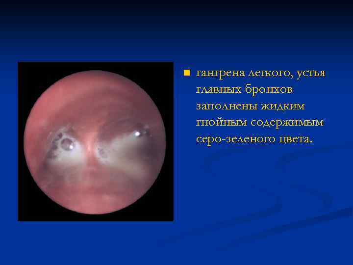 n гангрена легкого, устья главных бронхов заполнены жидким гнойным содержимым серо-зеленого цвета. 
