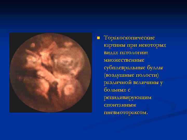 n Торакоскопические картины при некоторых видах патологии: множественные субплевральные буллы (воздушные полости) различной величины