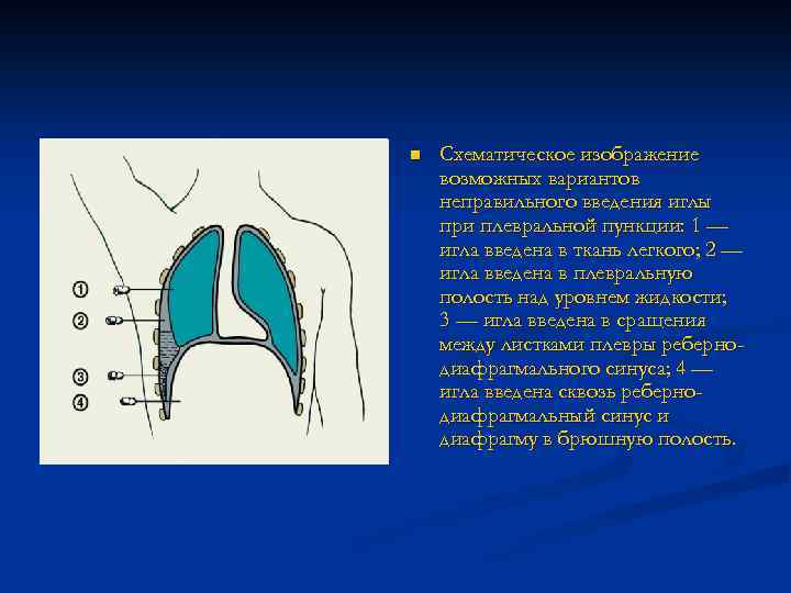 n Схематическое изображение возможных вариантов неправильного введения иглы при плевральной пункции: 1 — игла
