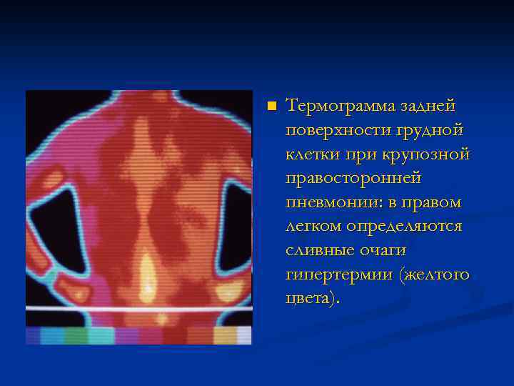 n Термограмма задней поверхности грудной клетки при крупозной правосторонней пневмонии: в правом легком определяются