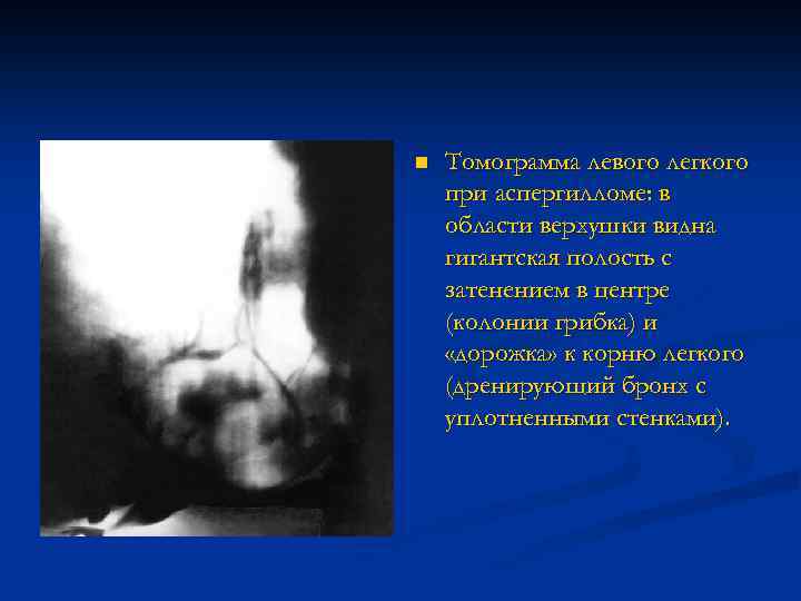 n Томограмма левого легкого при аспергилломе: в области верхушки видна гигантская полость с затенением