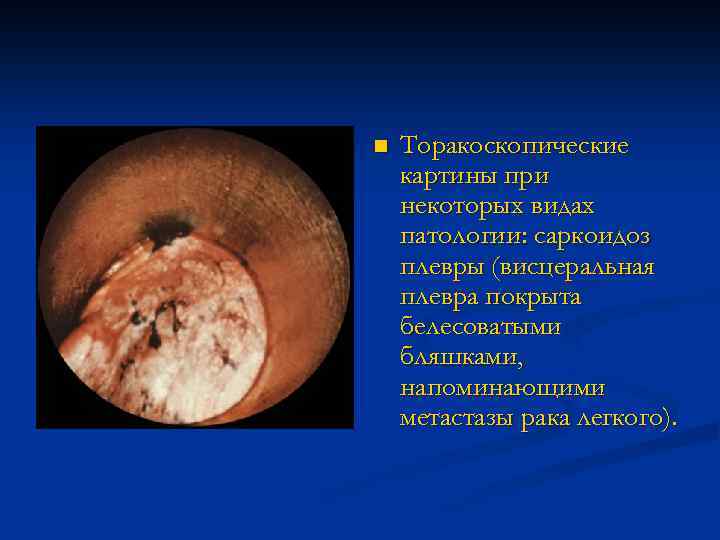n Торакоскопические картины при некоторых видах патологии: саркоидоз плевры (висцеральная плевра покрыта белесоватыми бляшками,