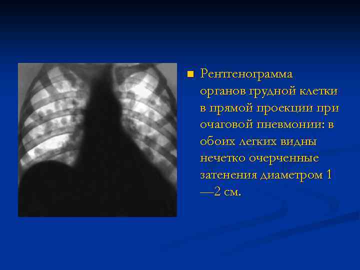 n Рентгенограмма органов грудной клетки в прямой проекции при очаговой пневмонии: в обоих легких