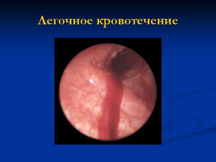 Легочное кровотечение 