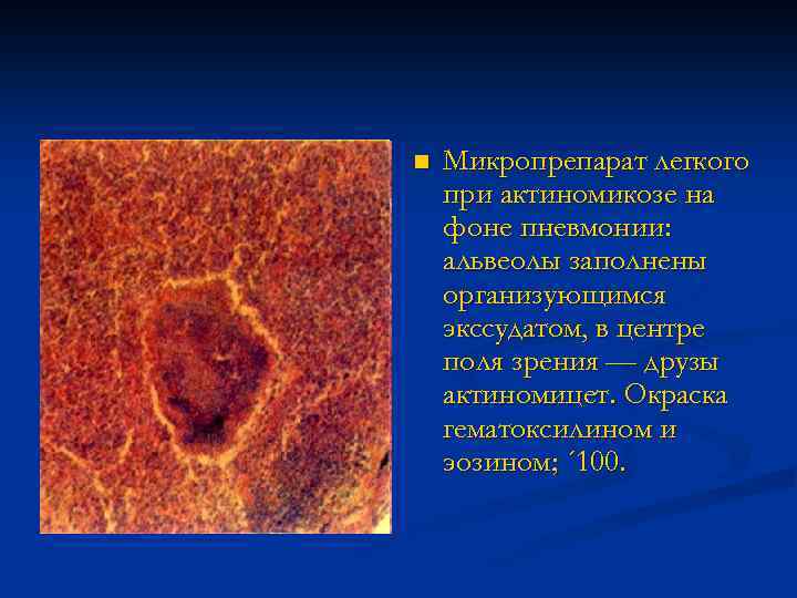 n Микропрепарат легкого при актиномикозе на фоне пневмонии: альвеолы заполнены организующимся экссудатом, в центре