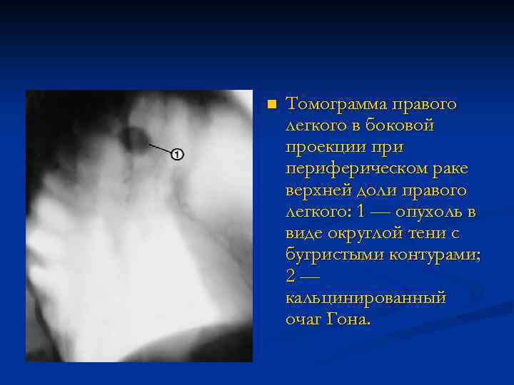 n Томограмма правого легкого в боковой проекции при периферическом раке верхней доли правого легкого: